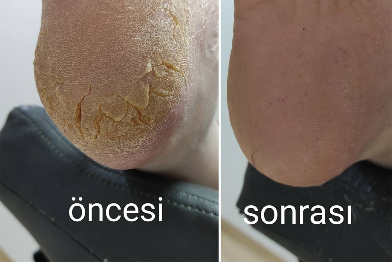  Mutlu Ayaklar, Diamond Ayak Sağlığı'ndan Geçer 