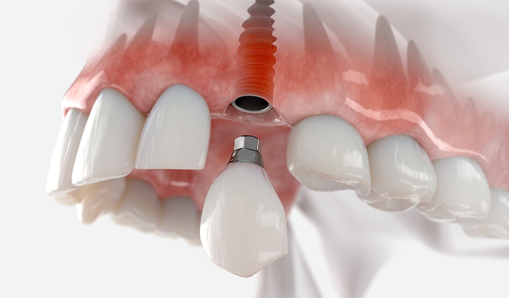 DİŞ EKSİKLİĞİNİN GİDERİLMESİNDE ALTIN STANDART  ’’DENTAL İMPLANTLAR’’